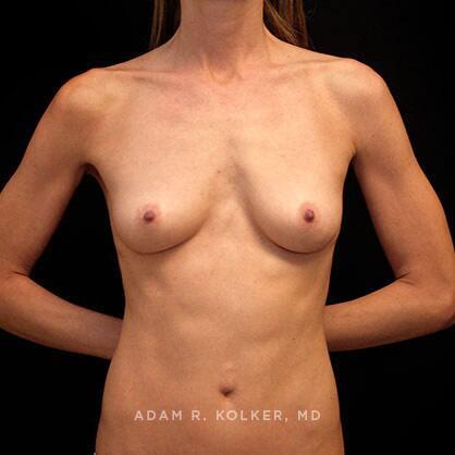 Breast Augmentation Before Image Patient 25 Front View