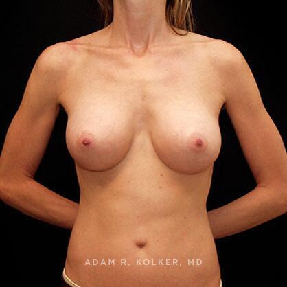Breast Augmentation After Image Patient 25 Front View