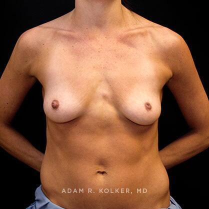 Breast Augmentation Before Image Patient 27 Front View