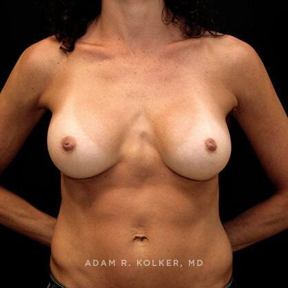 Breast Augmentation After Image Patient 27 Front View