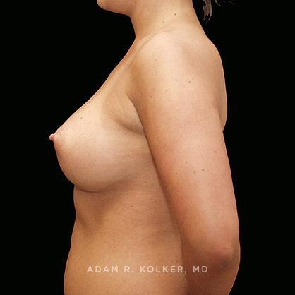 Breast Augmentation After Image Patient 28 Side View