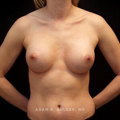 Breast Augmentation After Image Patient 31 Front View