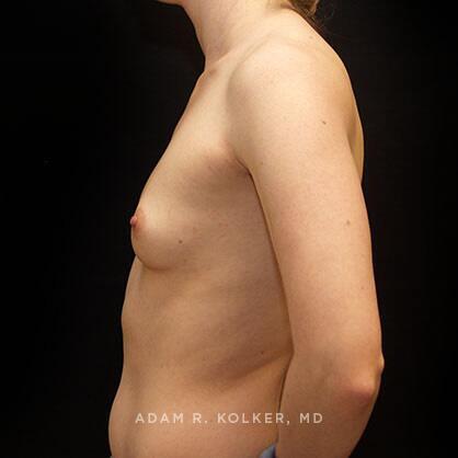 Breast Augmentation Before Image Patient 31 Side View