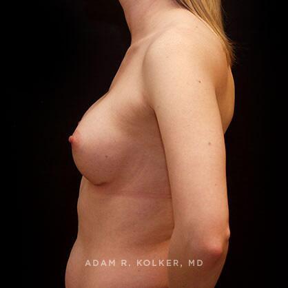 Breast Augmentation After Image Patient 31 Side View