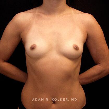 Breast Augmentation Before Image Patient 35 Front View