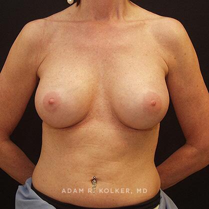 Breast Augmentation After Image Patient 36 Front View