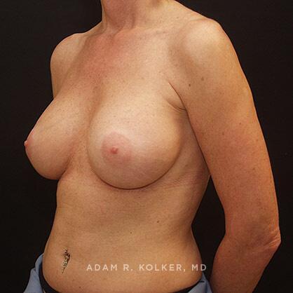 Breast Augmentation After Image Patient 36 Oblique View
