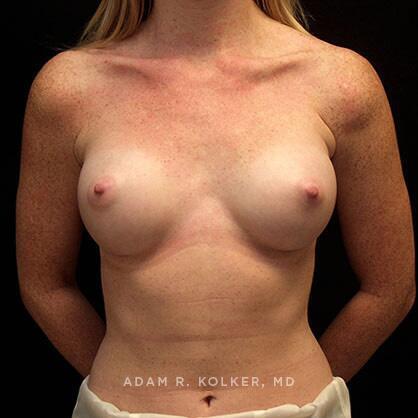 Breast Augmentation After Image Patient 37 Front View