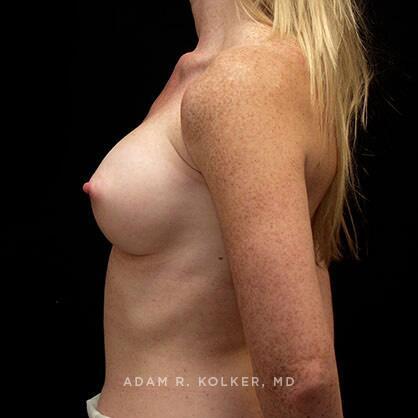 Breast Augmentation After Image Patient 37 Side View