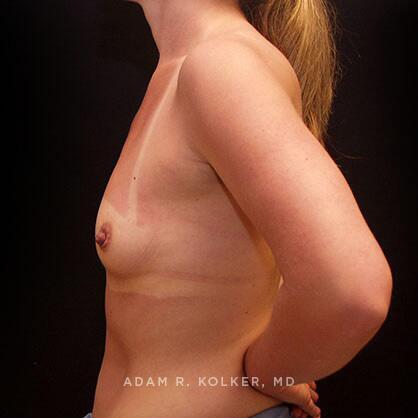 Breast Augmentation Before Image Patient 38 Side View