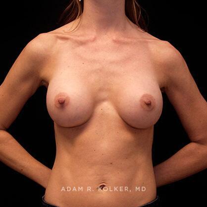 Breast Augmentation After Image Patient 39 Front View
