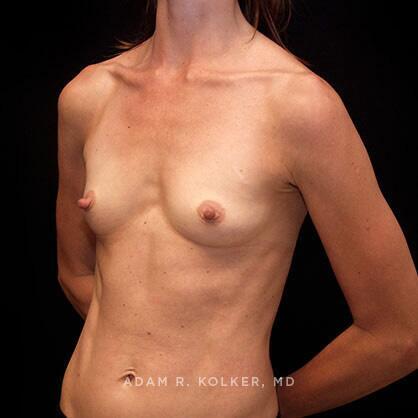 Breast Augmentation Before Image Patient 39 Oblique View