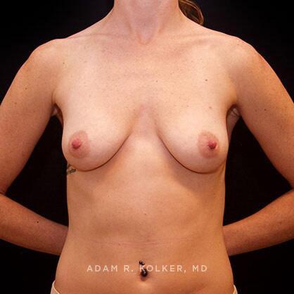 Breast Augmentation Before Image Patient 40 Front View
