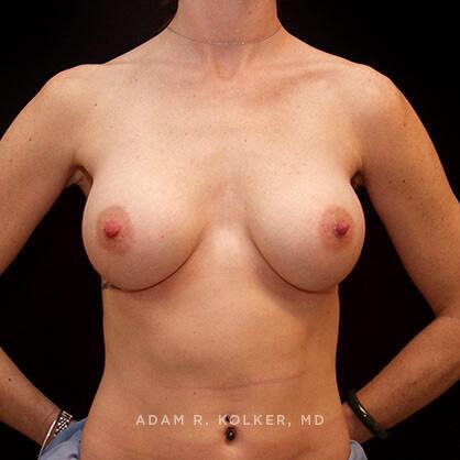 Breast Augmentation After Image Patient 40 Front View