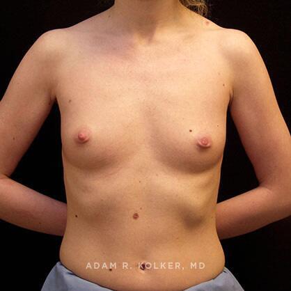 Breast Augmentation Before Image Patient 41 Front View