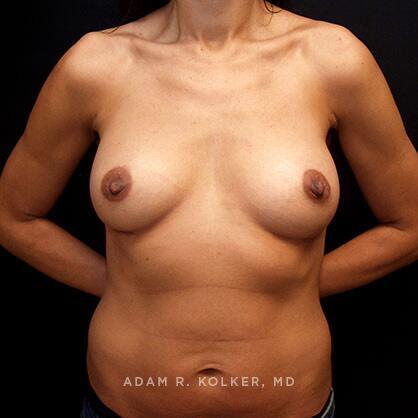 Breast Augmentation After Image Patient 42 Front View