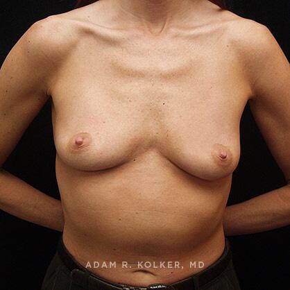 Breast Augmentation Before Image Patient 44 Front View