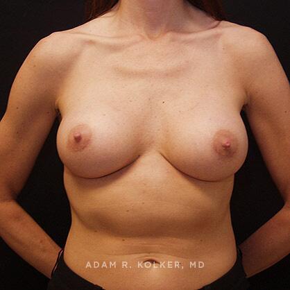 Breast Augmentation After Image Patient 44 Front View