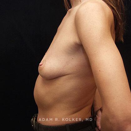 Breast Augmentation After Image Patient 44 Side View