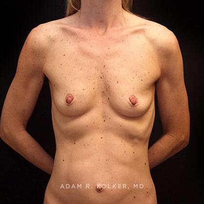 Breast Augmentation Before Image Patient 45 Front View