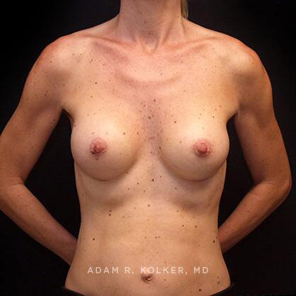 Breast Augmentation After Image Patient 45 Front View