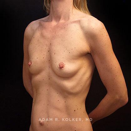 Breast Augmentation Before Image Patient 45 Oblique View