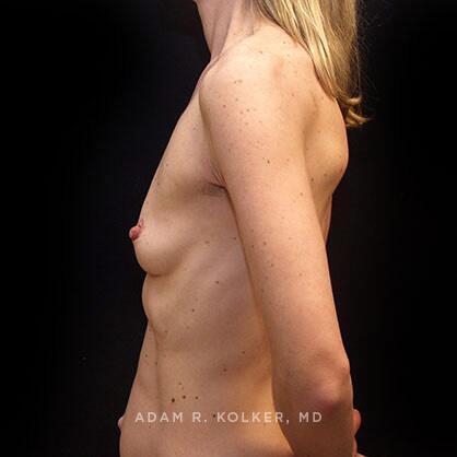 Breast Augmentation Before Image Patient 45 Side View