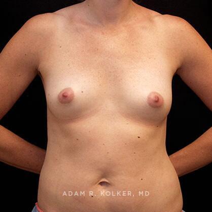 Breast Augmentation Before Image Patient 46 Front View