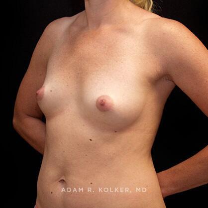 Breast Augmentation After Image Patient 46 Oblique View