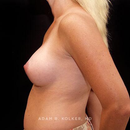 Breast Augmentation After Image Patient 46 Side View