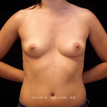 Breast Augmentation Before Image Patient 47 Front View