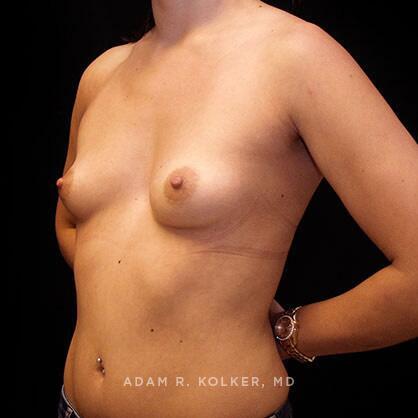 Breast Augmentation Before Image Patient 47 Oblique View
