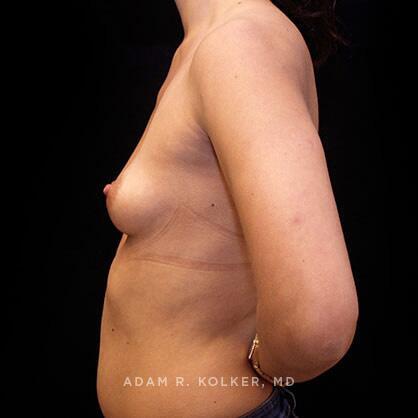 Breast Augmentation Before Image Patient 47 Side View
