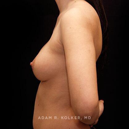 Breast Augmentation After Image Patient 47 Side View