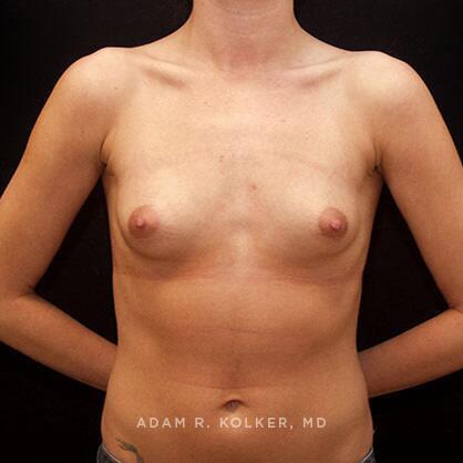Breast Augmentation Before Image Patient 51 Front View