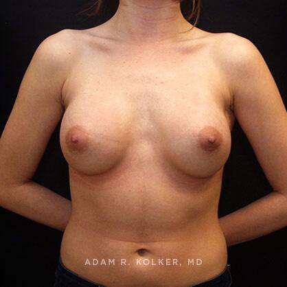 Breast Augmentation After Image Patient 51 Front View
