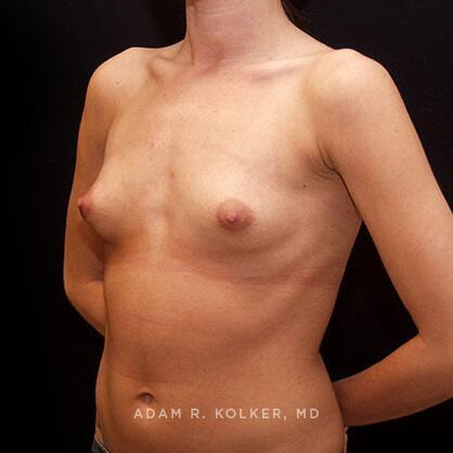 Breast Augmentation Before Image Patient 51 Oblique View