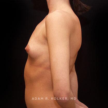 Breast Augmentation Before Image Patient 51 Side View