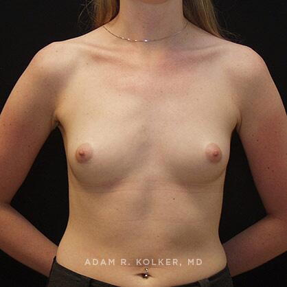 Breast Augmentation Before Image Patient 52 Front View