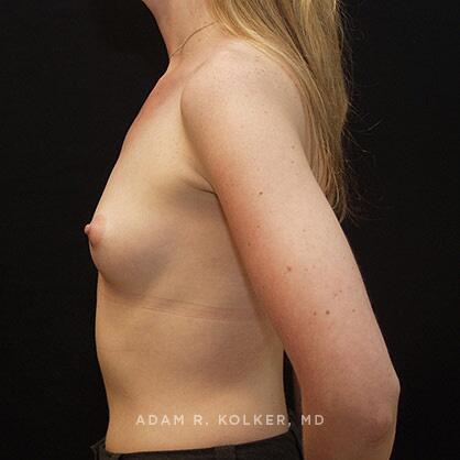 Breast Augmentation Before Image Patient 52 Side View