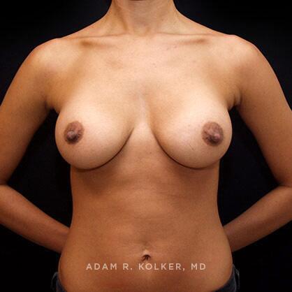 Breast Augmentation After Image Patient 54 Front View