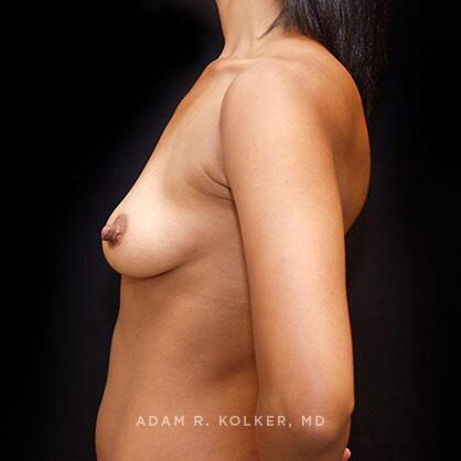 Breast Augmentation Before Image Patient 54 Side View