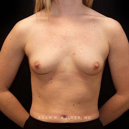Breast Augmentation Before Image Patient 55 Front View