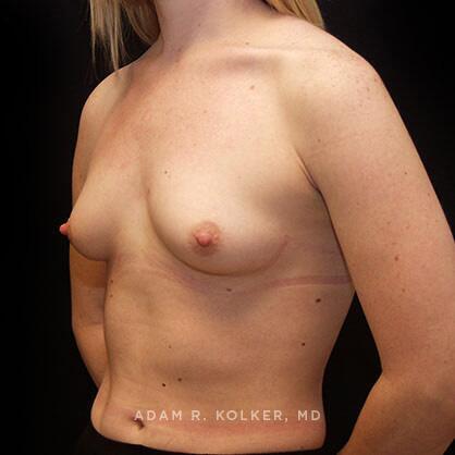 Breast Augmentation Before Image Patient 55 Oblique View