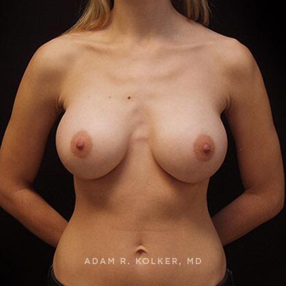 Breast Augmentation After Image Patient 57 Front View