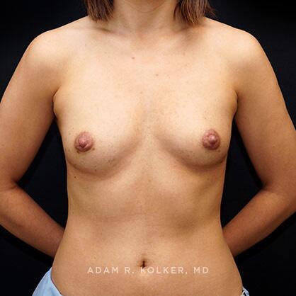 Breast Augmentation Before Image Patient 59 Front View