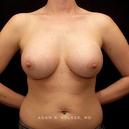 Breast Augmentation After Image Patient 62 Front View