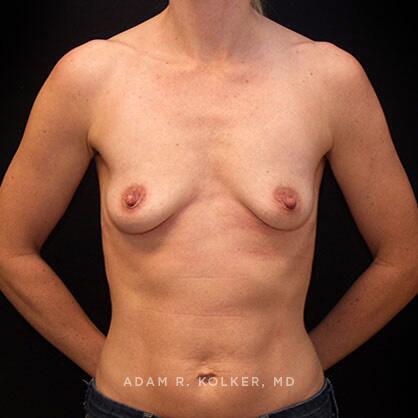 Breast Augmentation Before Image Patient 64 Front View