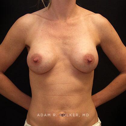 Breast Augmentation After Image Patient 64 Front View
