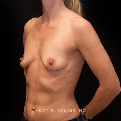 Breast Augmentation Before Image Patient 64 Oblique View